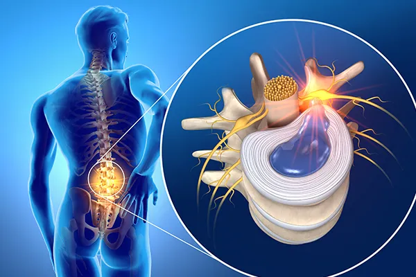 ヘルニアの図解