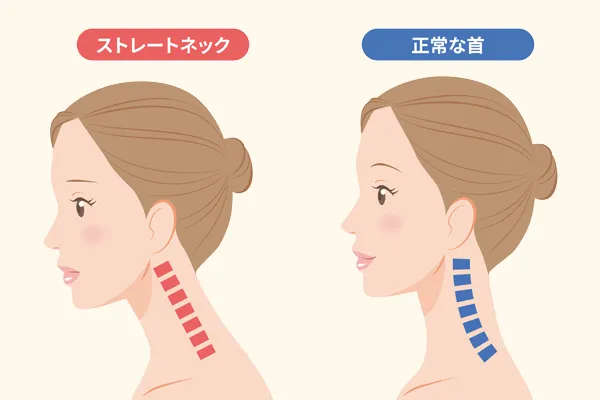 ストレートネック図解